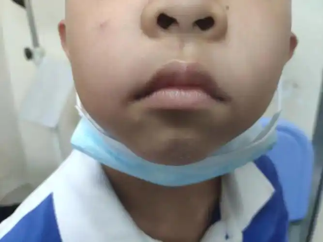医生看了,说已经出现腺样体面容,为什么我们小孩腺样体不大,却已经有