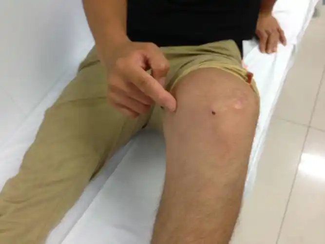 膝关节专家门诊膝关节内侧疼痛之膝关节内侧副韧带损伤问答