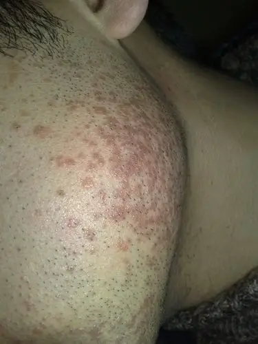 专家看看是什么病怎么样治疗好推荐好方法