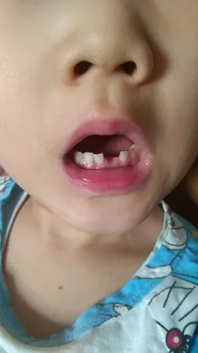 第一次掉牙