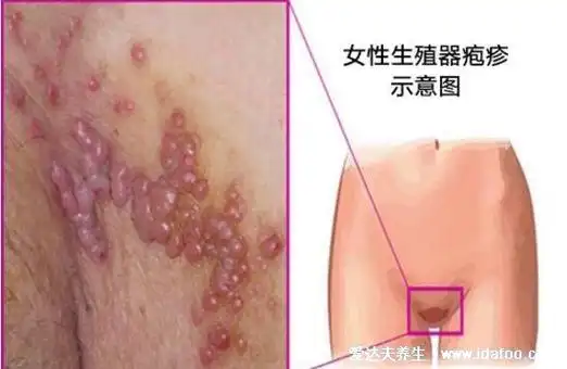 花柳病初期皮疹图片及症状,梅毒/淋病/尖锐湿疣/生殖器疱疹