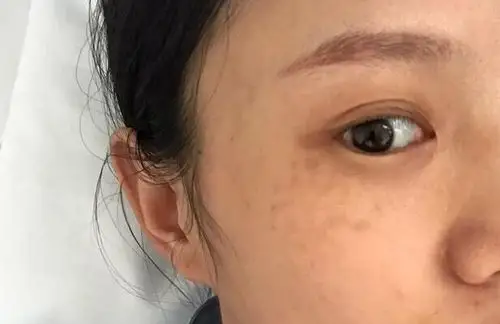 妊娠斑也叫黄褐斑,30岁宝妈生完孩子斑点迟迟不褪