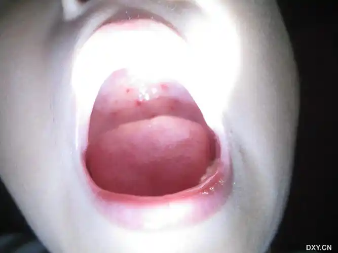 【求助】小儿咳嗽3天,发热1天,上颚有出血点