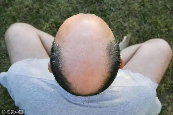 为什么会梦到自己秃了(昨晚梦见自己秃顶了怎么回事)