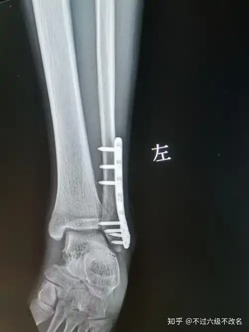 腓骨骨折 - 知乎