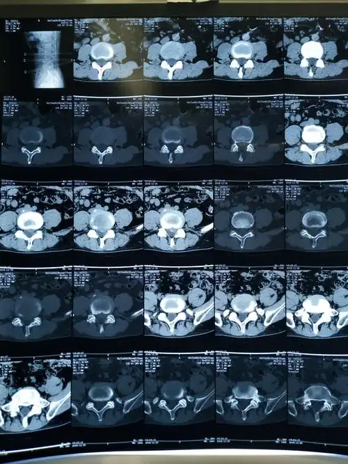 巨大突出物椎间孔镜取出