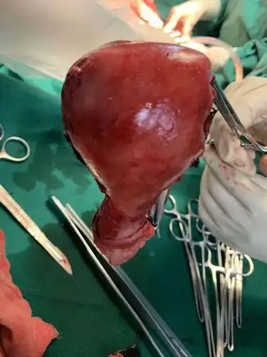 2020年8月22日威宁博爱医院妇产科和妇一科做第二台子宫全切手术.