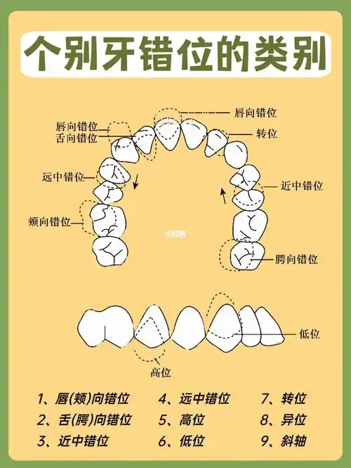或根冠位于牙弓舌(腭)侧[三r]近中错位牙向近中倾斜或移位[四r]远中