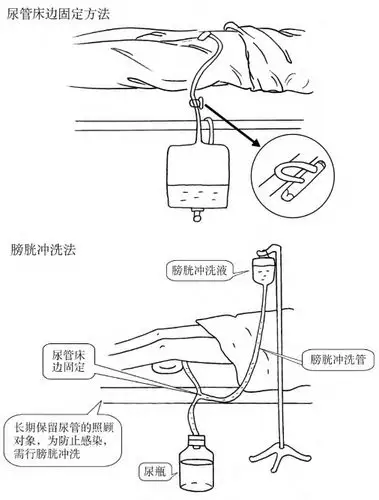 导尿是利用导尿管经尿道插入膀胱,将尿液排出体外.