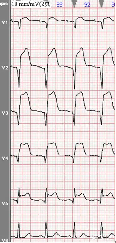 心电图课堂|第7期(下):急性心肌梗死的演变与定位