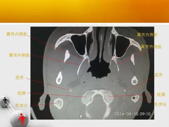 原创 颞骨断层轴位ct(完整篇)安阳市中医院耳鼻咽喉科