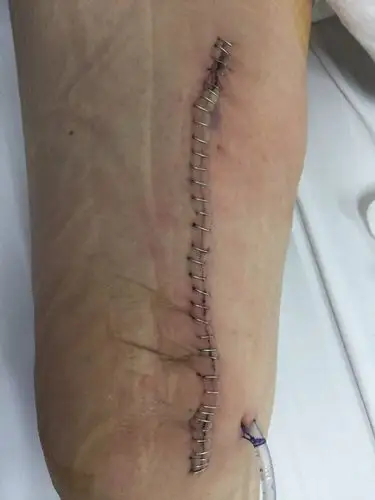 漳平市医院可以拆手术缝合钉吗