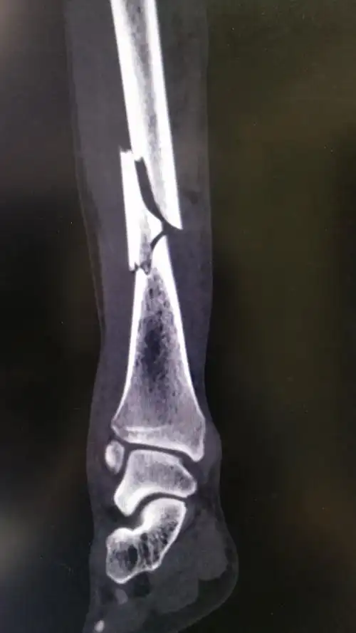 胫,腓骨骨折 - 好大夫在线