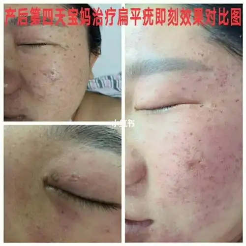 扁平疣应去正规机构治疗_药膏_敏感肤质_化妆品_护肤品_医疗健康_医疗