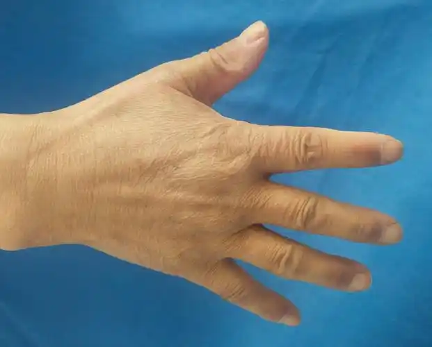 尽早手术,神经松解肘部神经卡压萎缩与正常手鱼际肌肉萎缩,感觉麻木