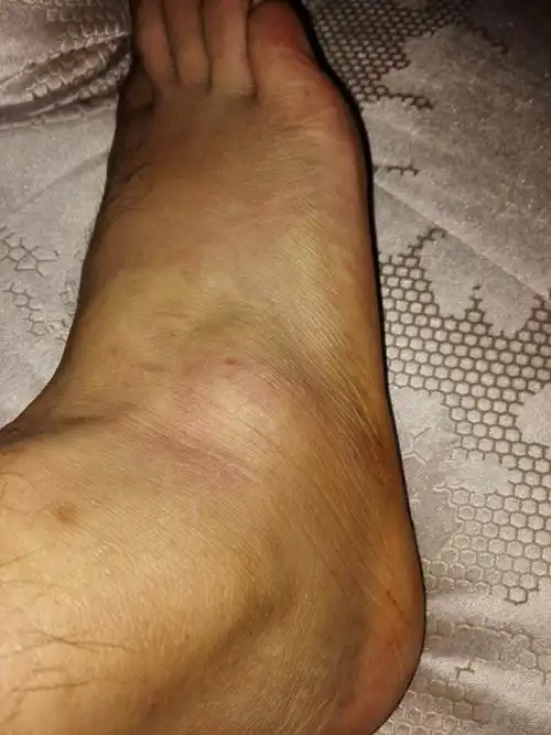 我脚扭伤了,还是肿了的,特别想去游泳!