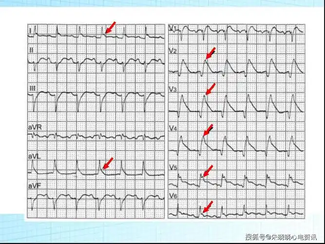 心电图背后的故事诡异的st段抬高