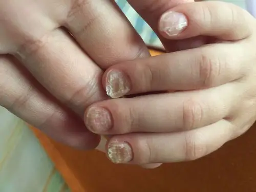 我女儿今年五岁半,从三岁多开始,她的指甲就有点凹凸不平,刚开始没