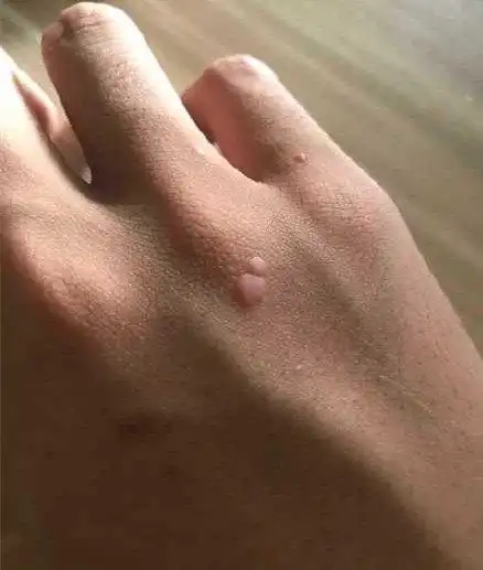 手背扁平疣_扁平疣_介绍_治疗方式 - 好大夫在线