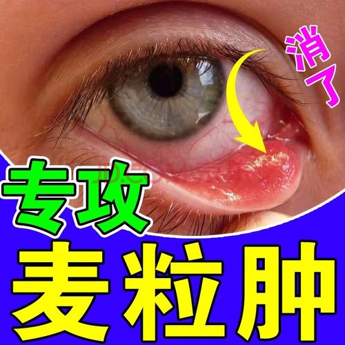 【旗舰优选】【麦粒肿眼贴】麦粒肿眼贴霰粒肿睑板腺堵塞视物模糊沙眼