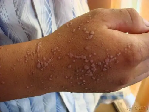 泛发性扁平疣 - 皮肤及性传播疾病讨论版 - 爱爱医医学论坛 - 爱爱医