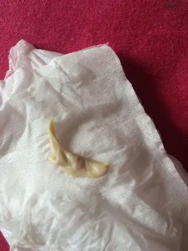 六个多月的宝宝鸡鸡里有条状分泌物出来怎么回事