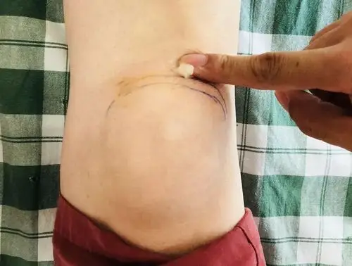 王女士的病情判断,她的膝关节疼痛主要是由于髌下脂肪垫受寒造成的,并