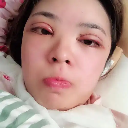 坐标上海双眼皮第十五天