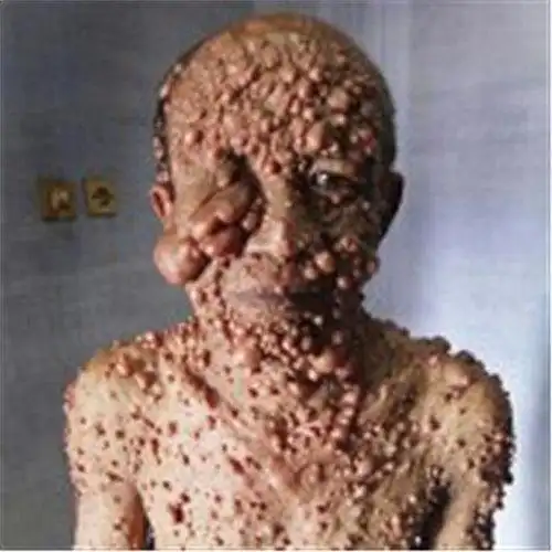 手臂皮下脂肪瘤图片