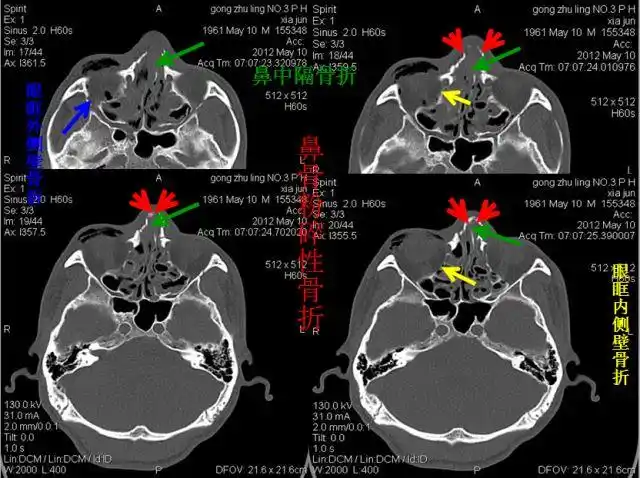 右下:上颌骨额突骨折左下:上颌窦前壁骨折左上:颚骨骨折下颌骨双侧