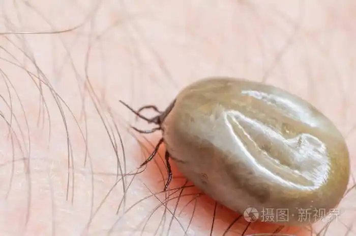 满腔热血坐在人体皮肤上的蜱虫