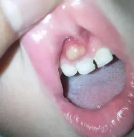 宝宝上牙龈鼓牙包是怎么回事