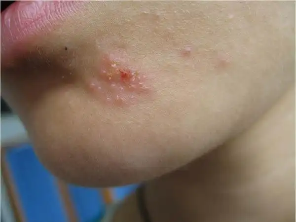 单纯疱疹如何诊断_医学知识全接触_按疾病找科普知识_挂号通