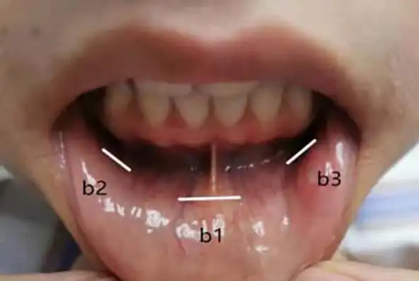 唐山市人民医院普外一科成功开展经口腔前庭腔镜甲状腺手术