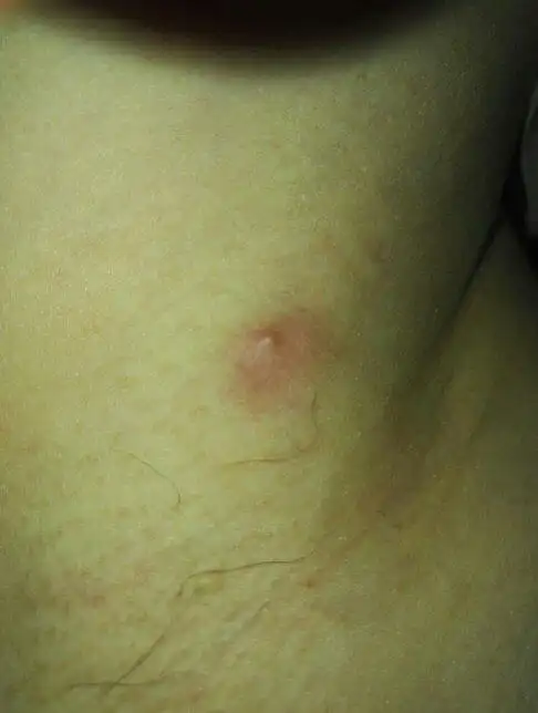 腋窝有一小疙瘩,红肿,手压有疼痛感,位置固定.是什么?