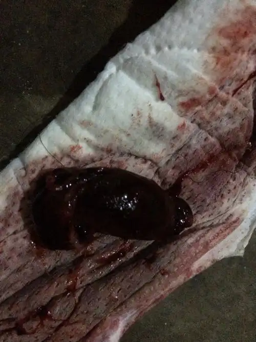 怀孕50天了,今天掉了两坨东西出来是不是孕囊