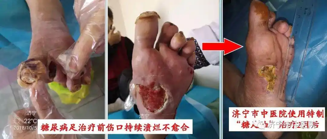 点赞中医妙法巧治糖尿病足让您摆脱截肢痛苦