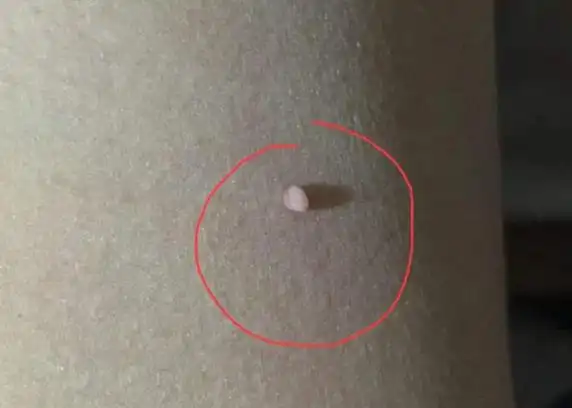 月经不调,经血发黑,量大3,身上长出菜花,鸡冠痘4,非经期出现滴状血迹