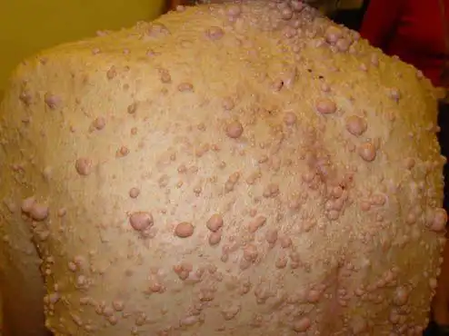 1型神经纤维瘤(nf1)