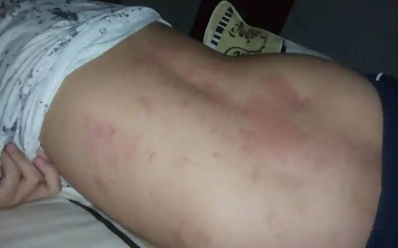 后背突然起了一大片红疙瘩 很痒 会蔓延