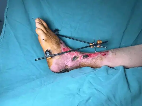 【临床聚集】惊魂瞬间—男子意外车祸左足离断,经开