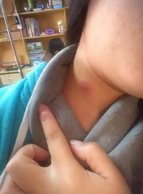 脖子上本来长了一个粉刺可是一夜之间变成了一个大包一碰就疼