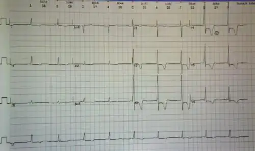 临床必备:2小时学看心肌缺血心电图