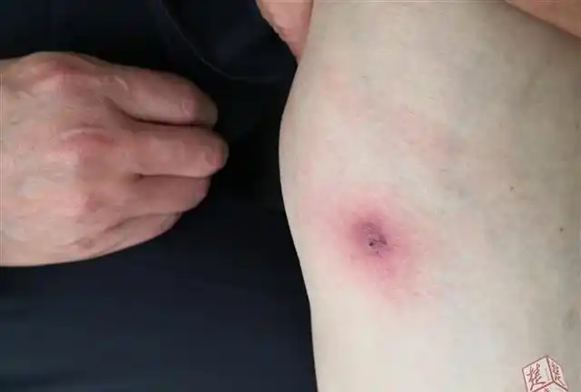 周边皮肤变得瘙痒难忍,到医院检查前,竟然从"黑痣"中钻出一只黑色蜱虫
