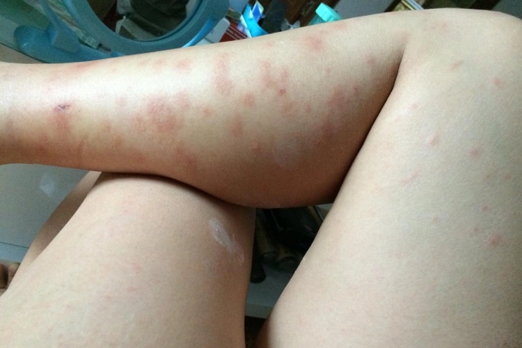 胸前长痘痘是什么原因艾滋病先从哪里长痘