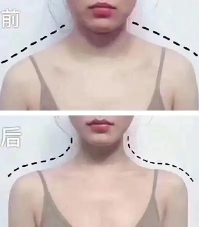瘦肩针效果真人前后对比图