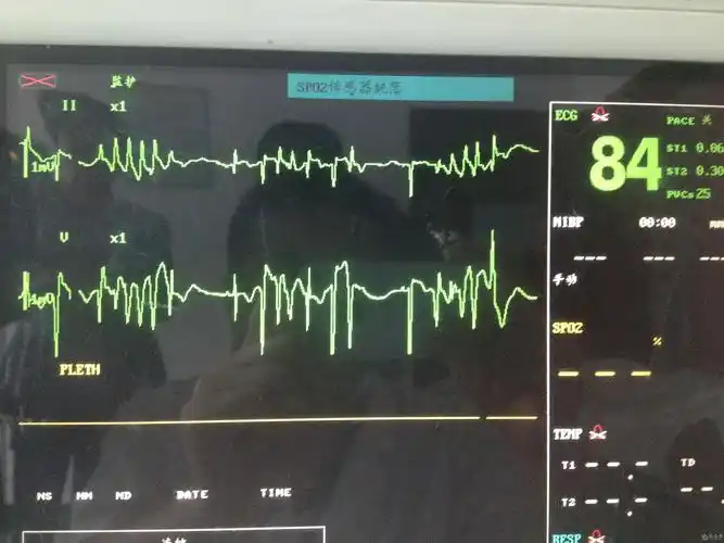 尖端扭转型室速一例 - 心电图脑电图专业讨论版 - 爱爱医医学论坛
