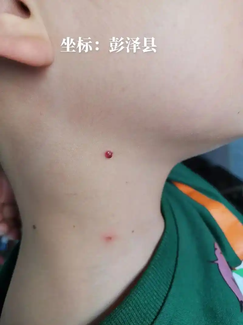 九江市彭泽县#彭泽县皮肤管理#彭泽县同城服务#血管瘤 - 抖音