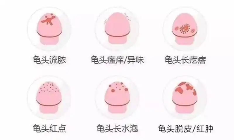 阿米巴性龟头炎图片