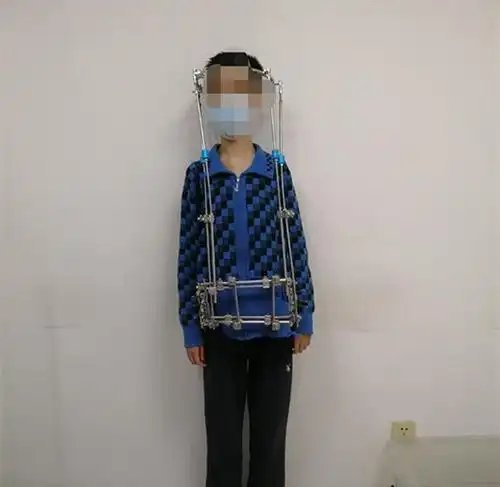 伴有心衰的严重脊柱侧弯的孩子,看得令人心疼,家长都该高度警惕